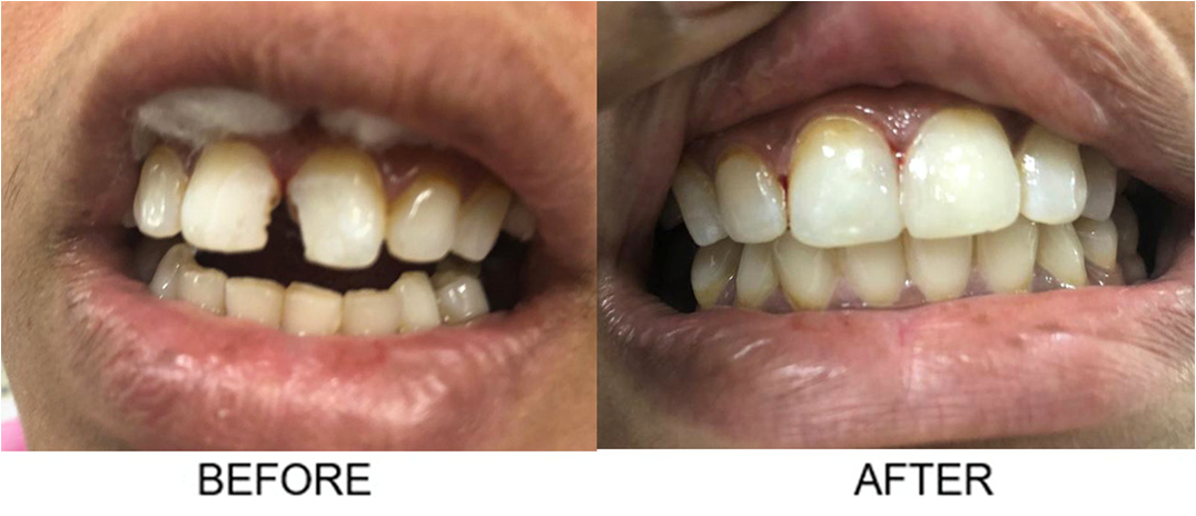 Fillings